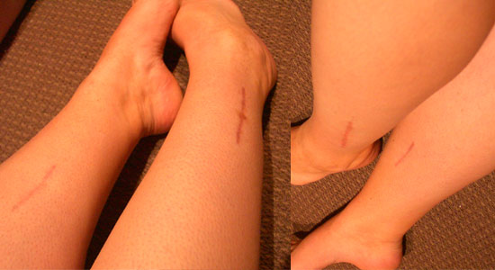 An image showing my compartment syndrome surgery scars. An image showing my compartment syndrome surgery scars.