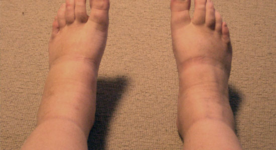 Swollen feet and ankles! Swollen feet and ankles!